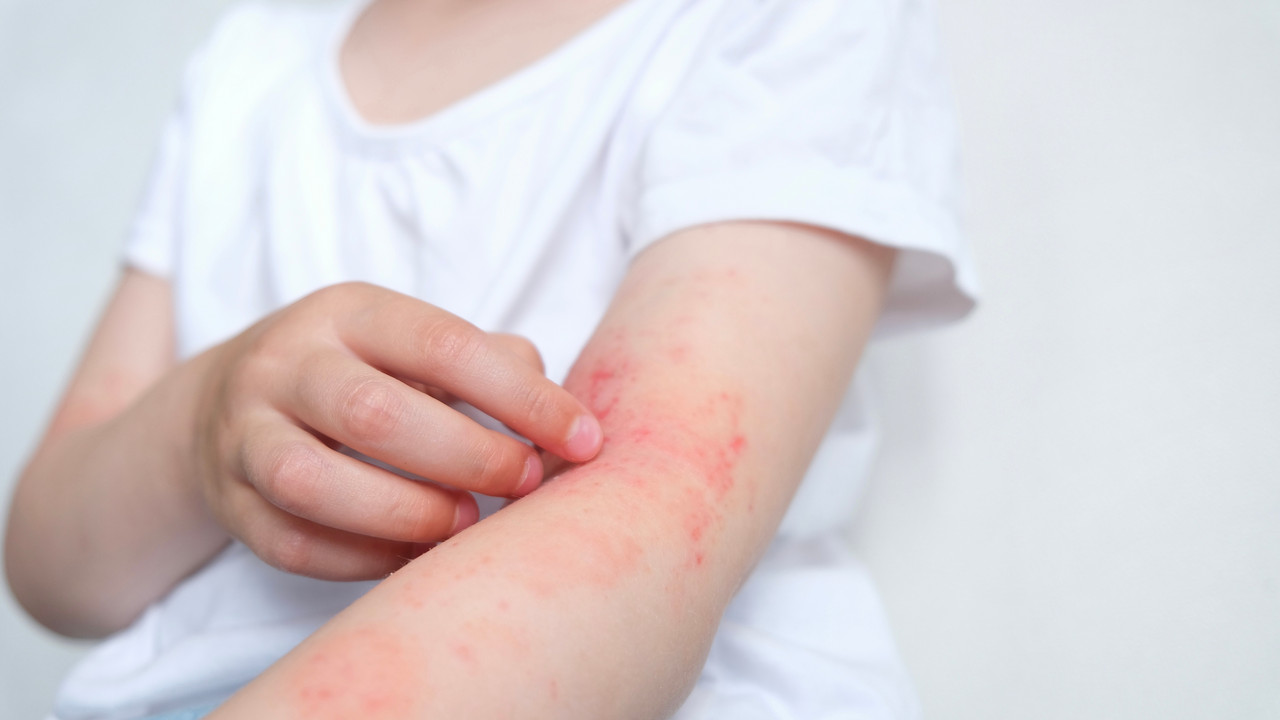 Atopijski dermatitis