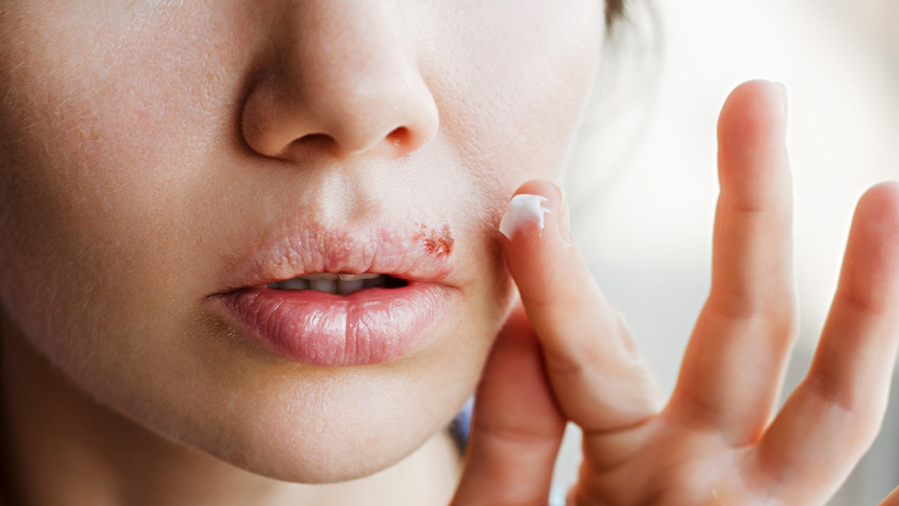 Herpes na usni