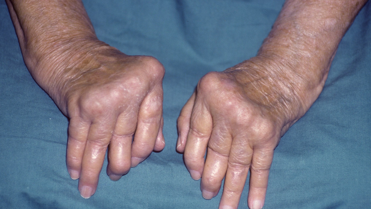 artritis