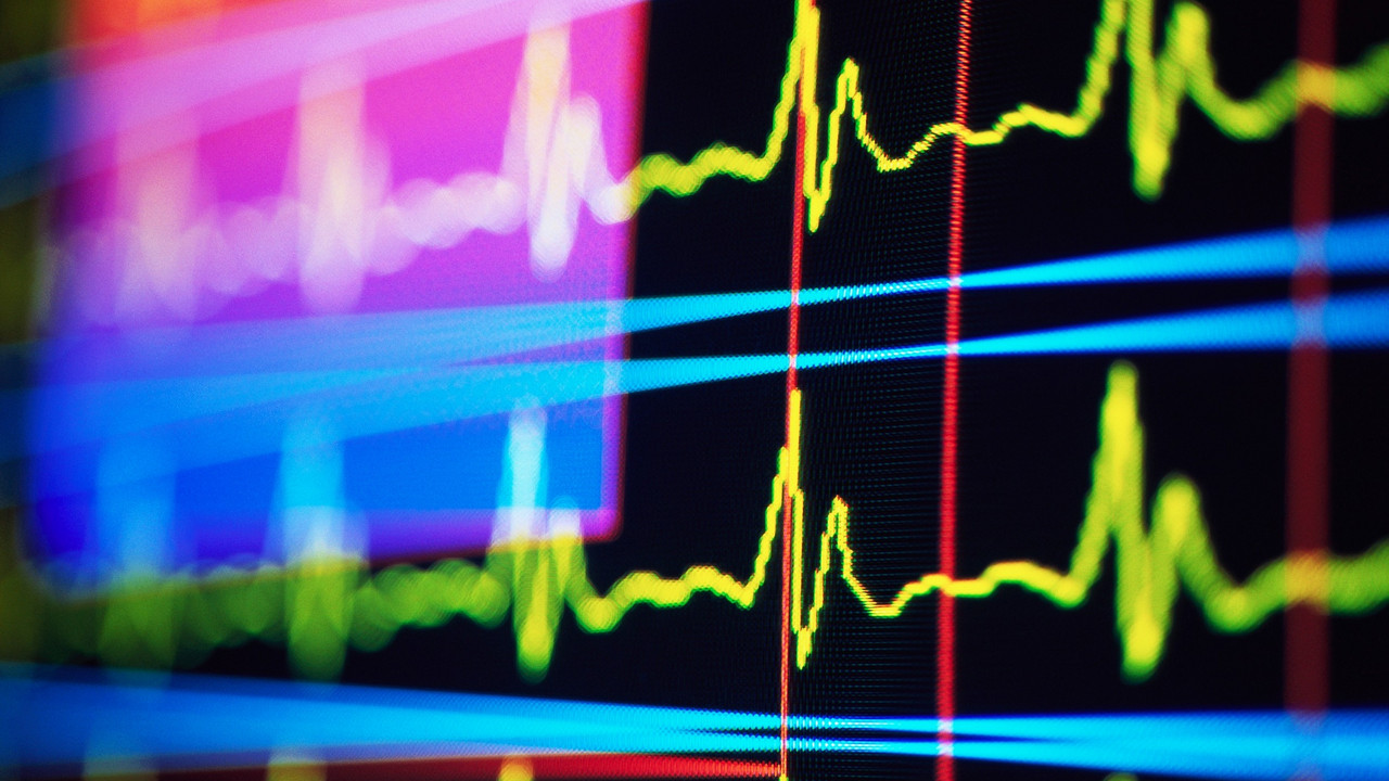 Ekg
