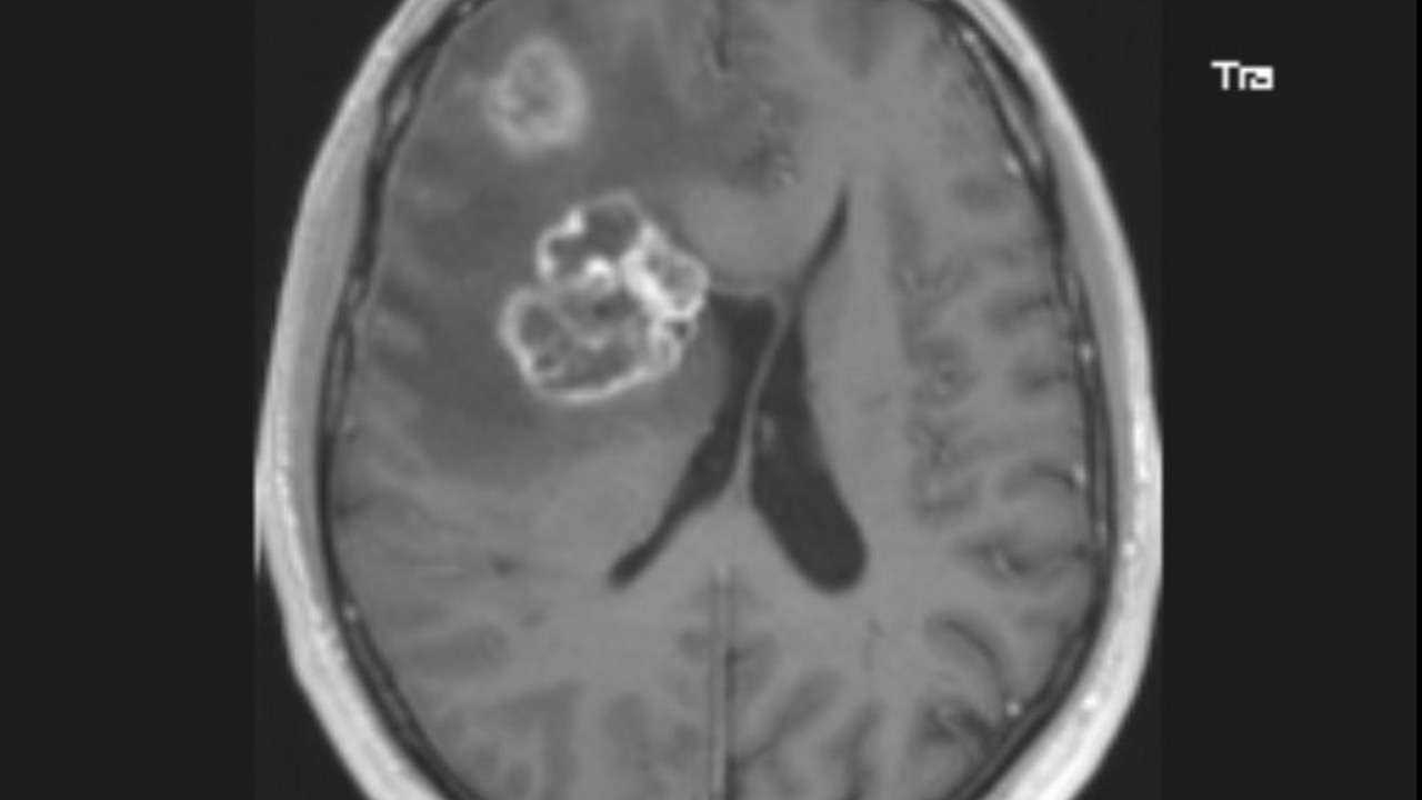 tumor na mozgu