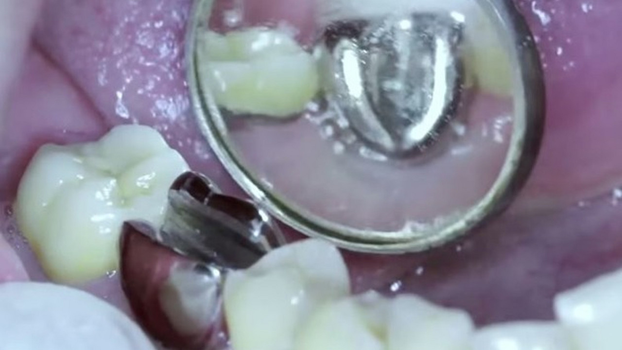 Implant za zub