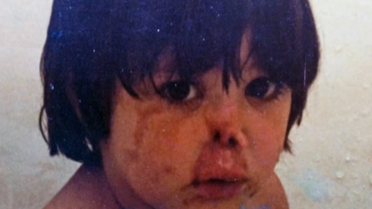 meningitis