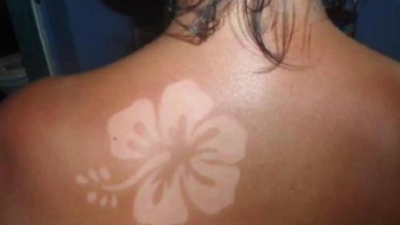 Sunburn Art