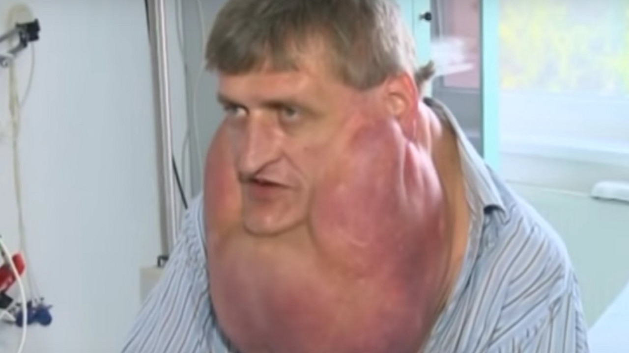 čovek sa masnim vlaknima na licu