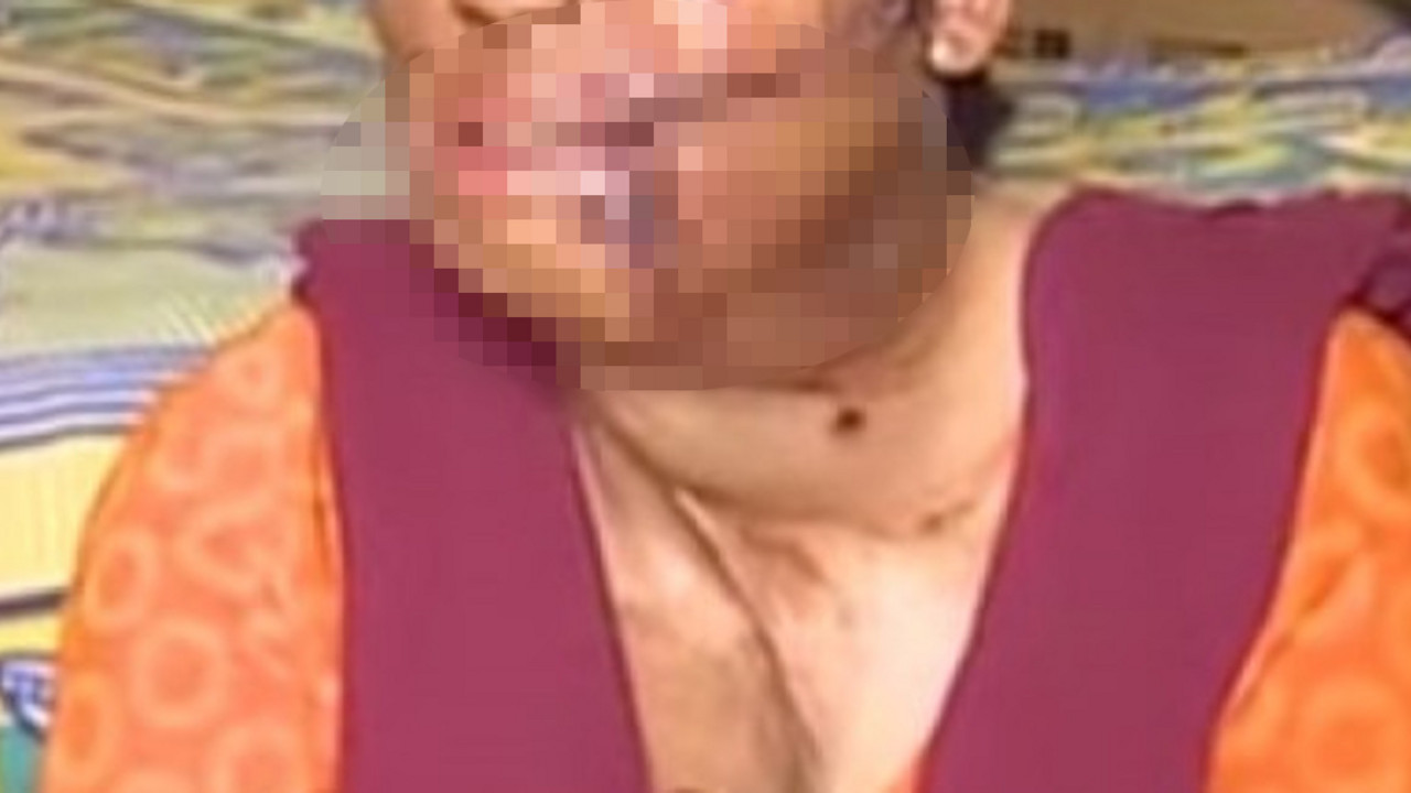 žena sa ožiljcima na licu