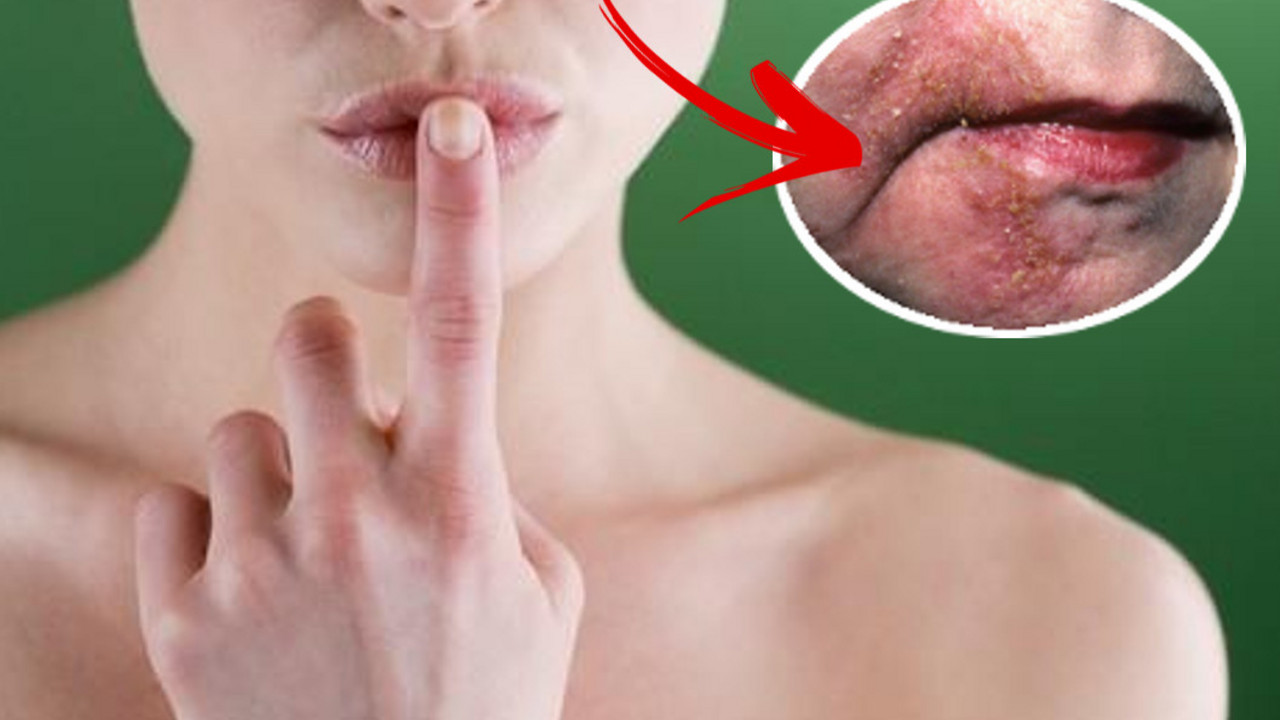 perioralni dermatitis