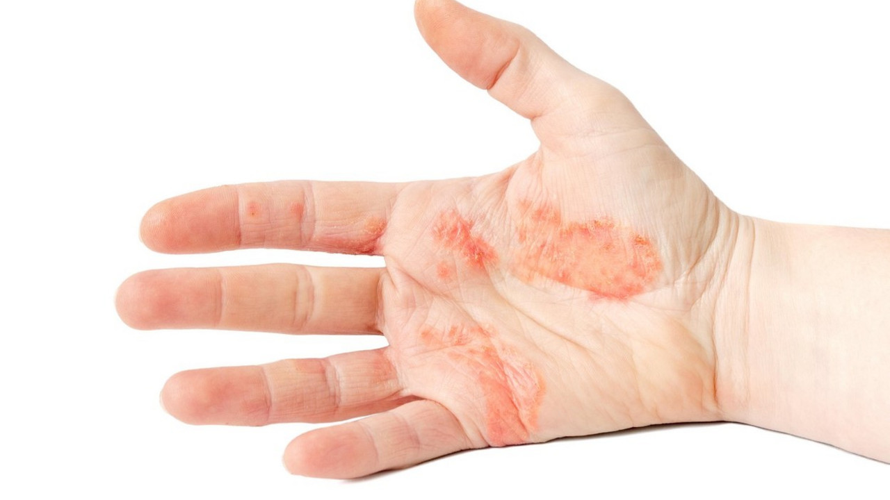 atopijski dermatitis