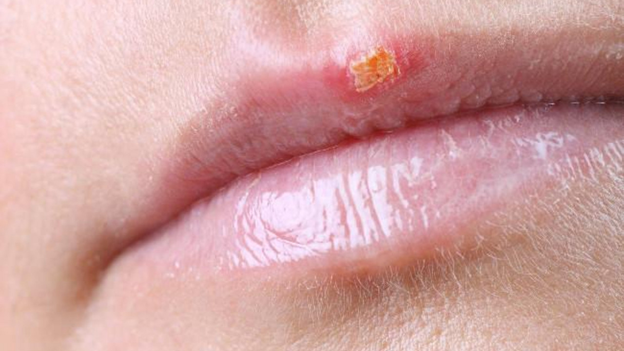 herpes