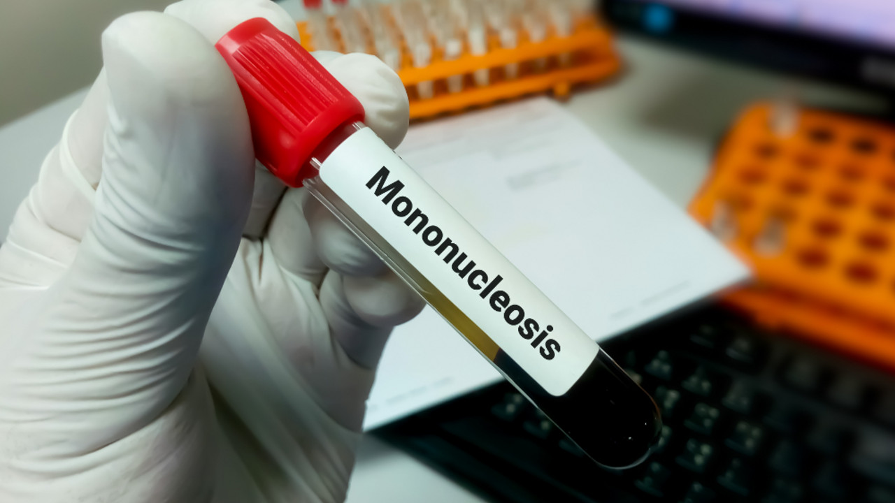 mononukleoza