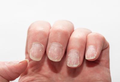 Grickate nokte? Posle ovog važnog upozorenja lekara, svi ćete prestati