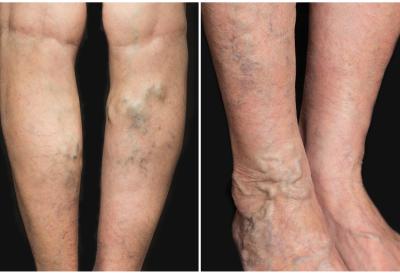 Najraniji SIGNAL da se u telu FORMIRAO TROMB: Nemojte ignorisati ove simptome!