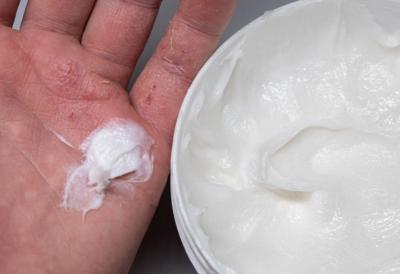 Narodni MELEM za ispucale ruke koji su koristile naše bake: Samo 10 minuta do vidljive razlike - koža mekša čak i posle rada na hladnoći