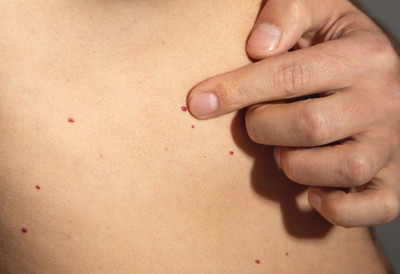 IZNENADA SU VAM SE POJAVILI CRVENI MLADEŽI? Dermatolozi objašnjavaju da li su opasni, kada treba da se javite lekaru i šta najviše utiče na zdravlje kože