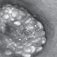 masa od čija semenki u jednjaku